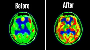 How Dopamine Detoxing Changed My Brain Preview